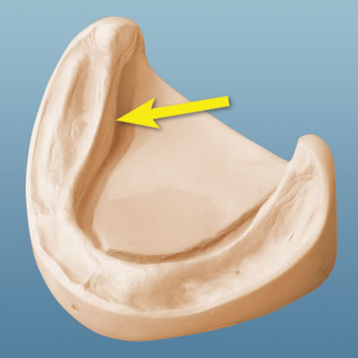 mylohyoid ridge denture
