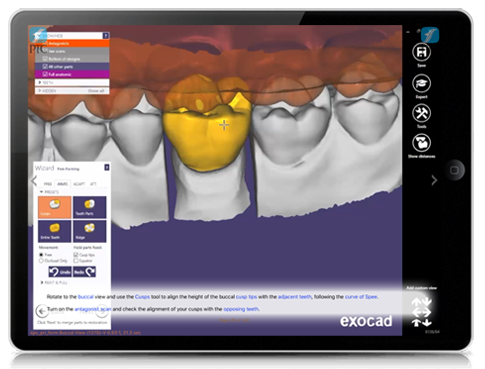 exocad Crowns
